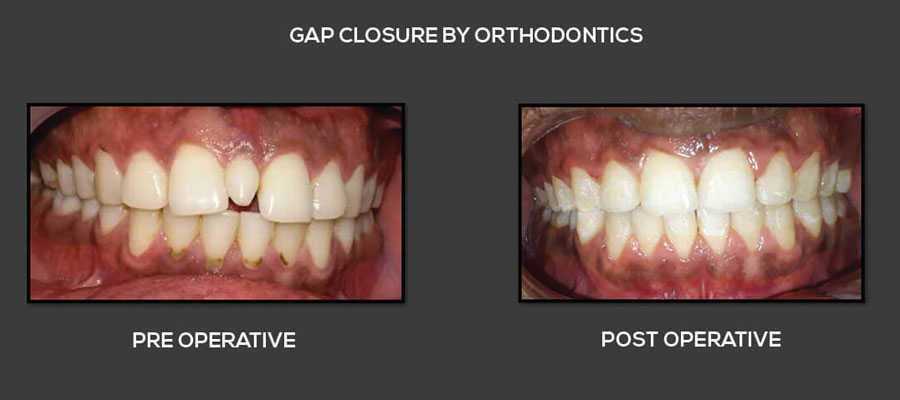 First slide